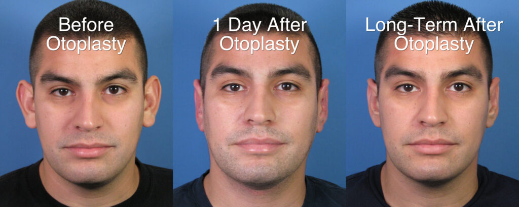 Ear Pinning Recovery What to Expect