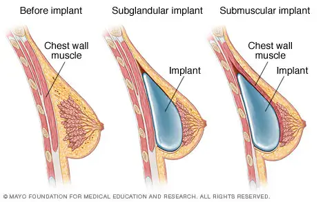What Is Breast Augmentation Surgery