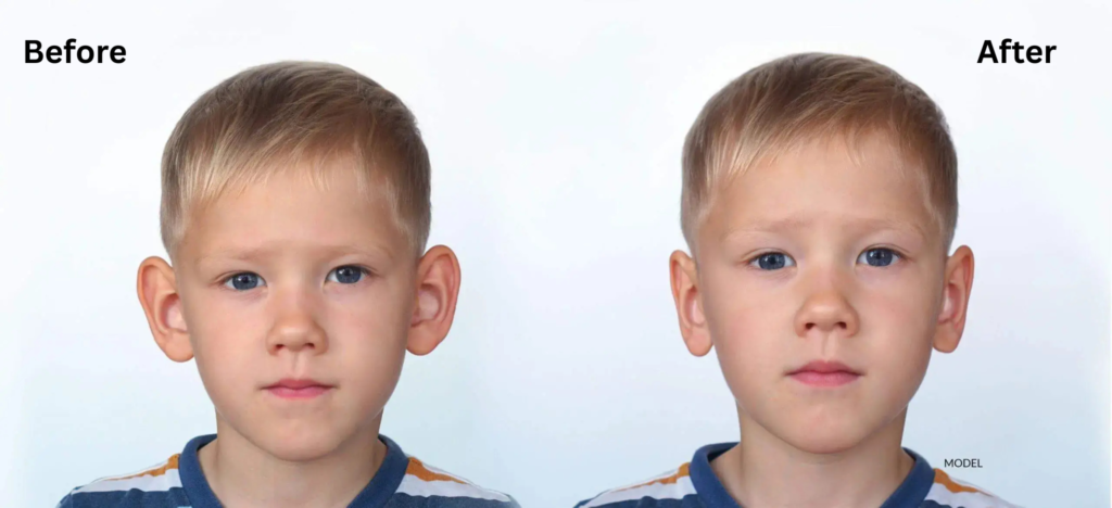 What's the Best Age for Otoplasty