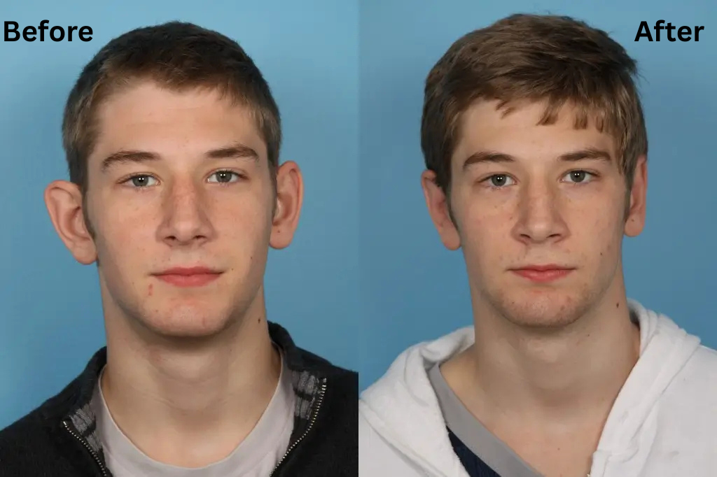 What's the Best Age for Otoplasty teenagers