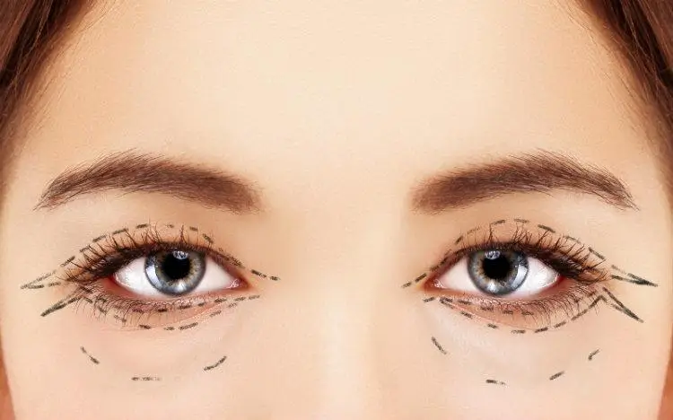 Eyelid Surgery Guide - Blepharoplasty Options