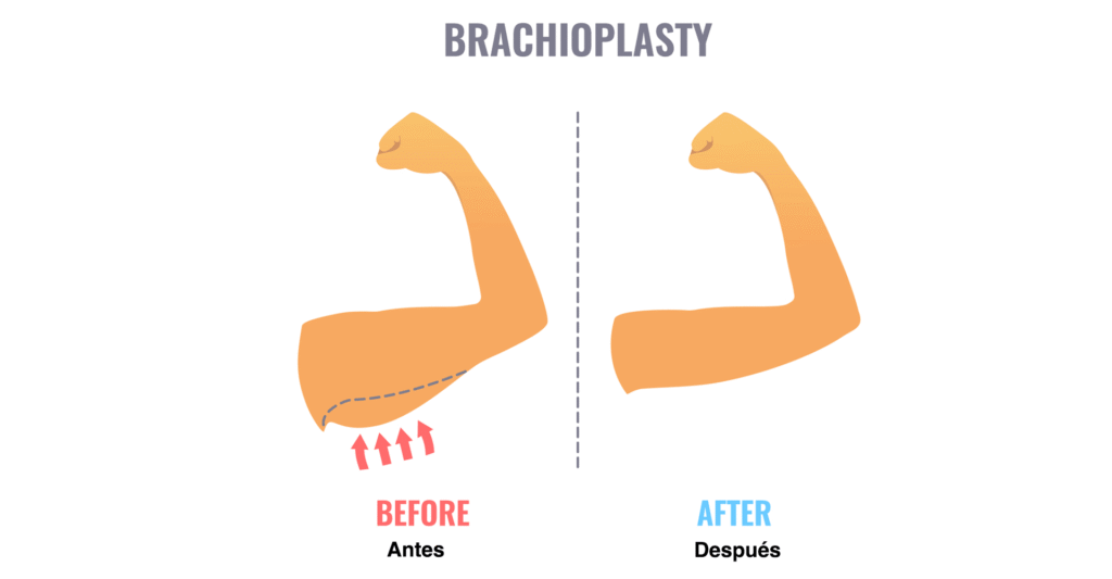 Brachioplasty Recovery Timeline Week by Week