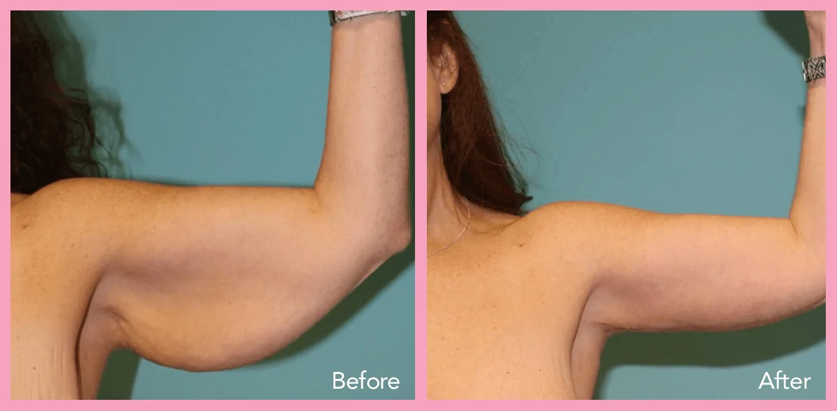Arm Lift