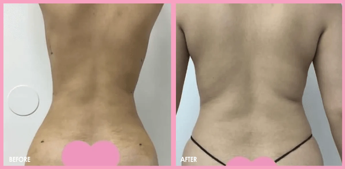 Brazilian Butt Lift