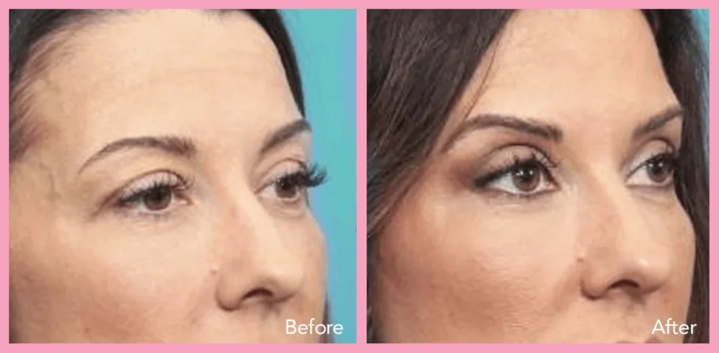 real eyelid surgery before & after results from our happy patients-3