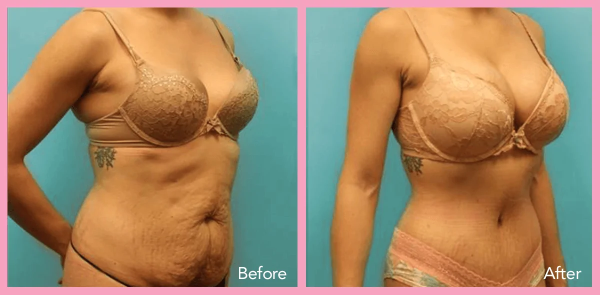 Mommy Makeover