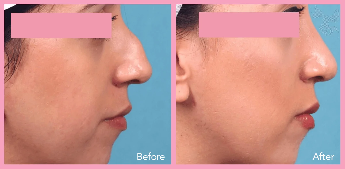 Rhinoplasty