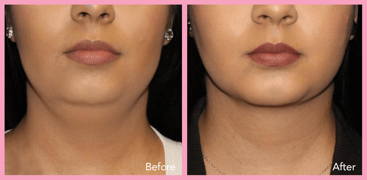 62912a1e59673308cc40ab0b_lipo-neck-and-jaw-6