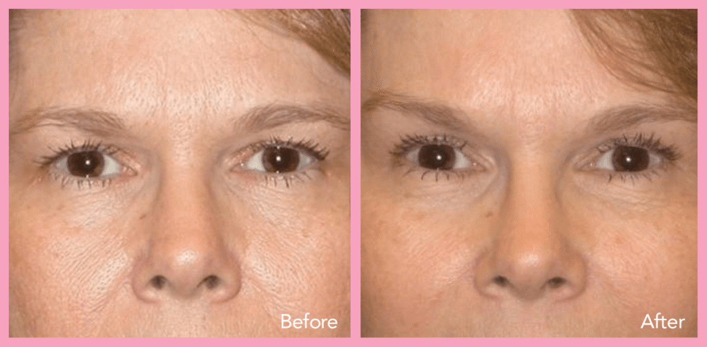 real eyelid surgery before & after results from our happy patients-2