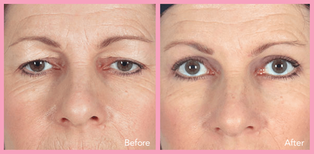 real eyelid surgery before & after results from our happy patients