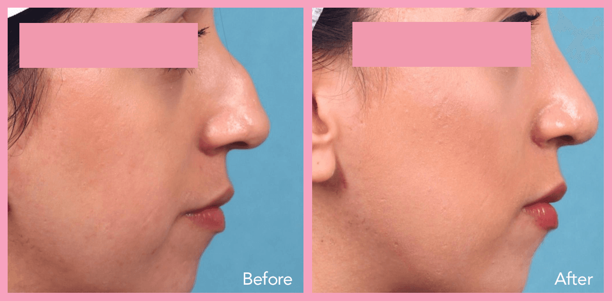 62912a1e59673368aa40aafb_nose-surgery-2-1