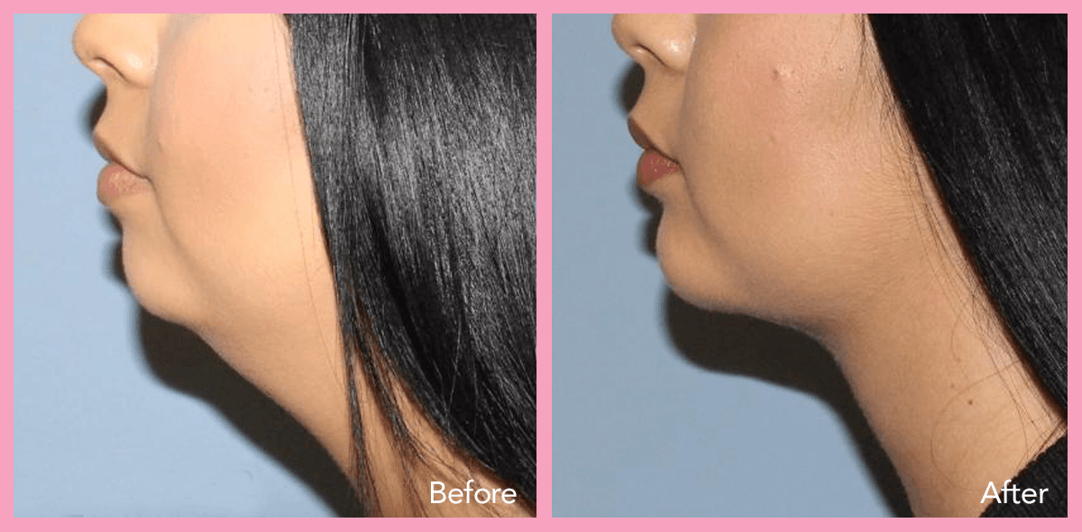 62912a1e59673375c740ab0a_Lipo-Neck-and-Jaw-5