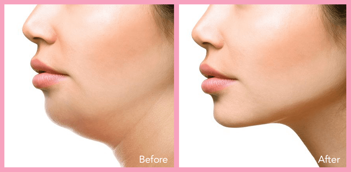 62912a1e5967338ac940aad9_lipo-Neck-and-jaw-1