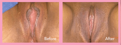 LABIAPLASTY 1