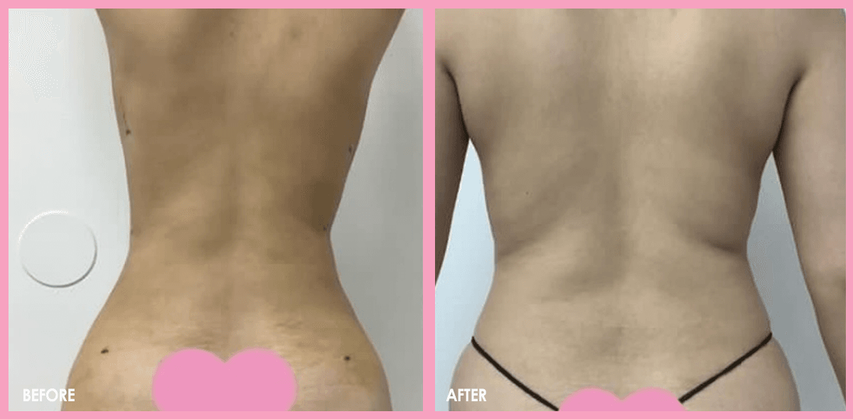 Liposuction 2
