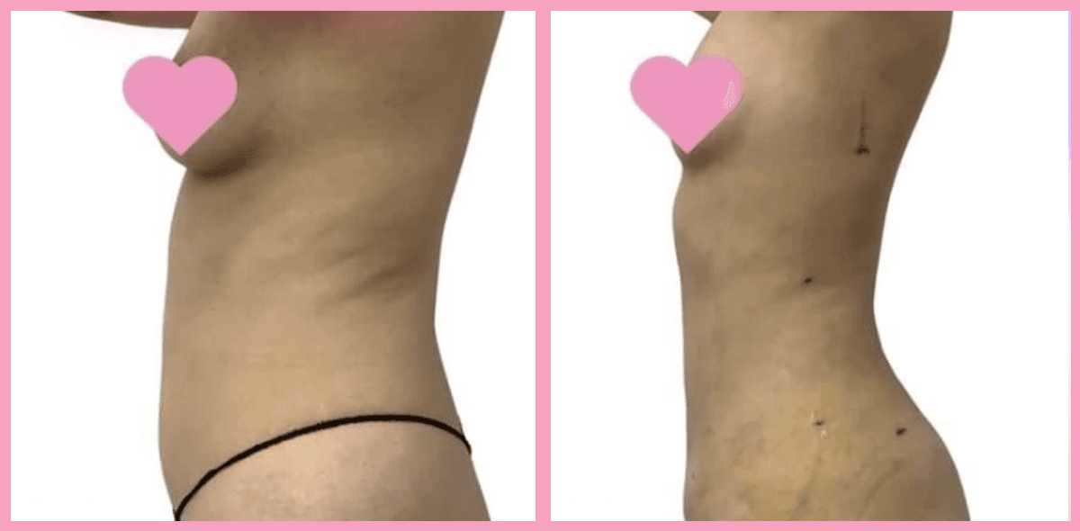 Liposuction 3