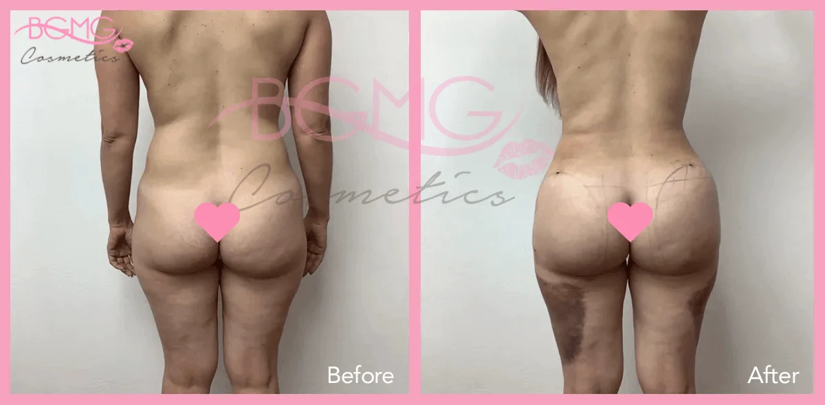 Brazilian Butt Lift Treatment - BBL Surgery Before and After Results 01