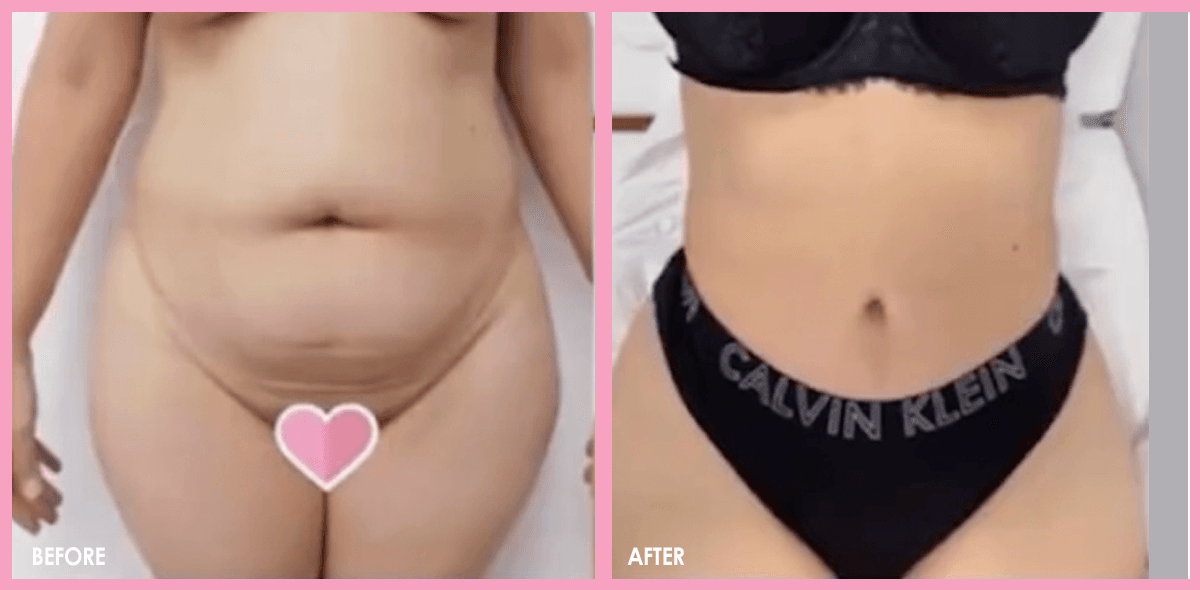 tummy tuck 2