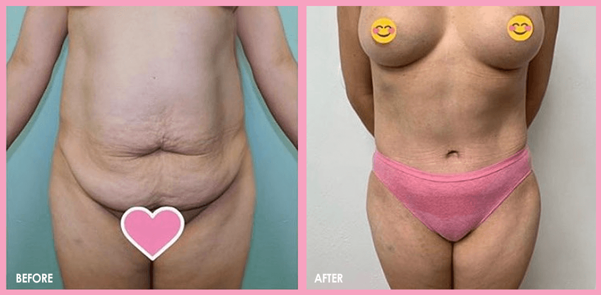 tummy tuck 3