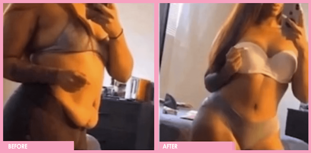 tummy tuck 3